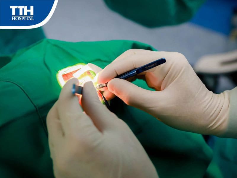 Mổ mắt Phaco là gì?