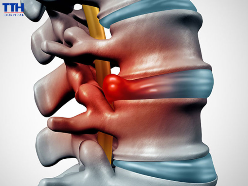  Ai dễ bị thoát vị đĩa đệm?