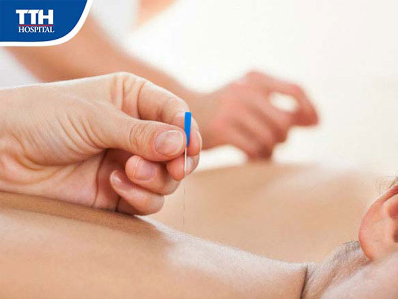 Cấy chỉ là gì và diễn ra như thế nào?