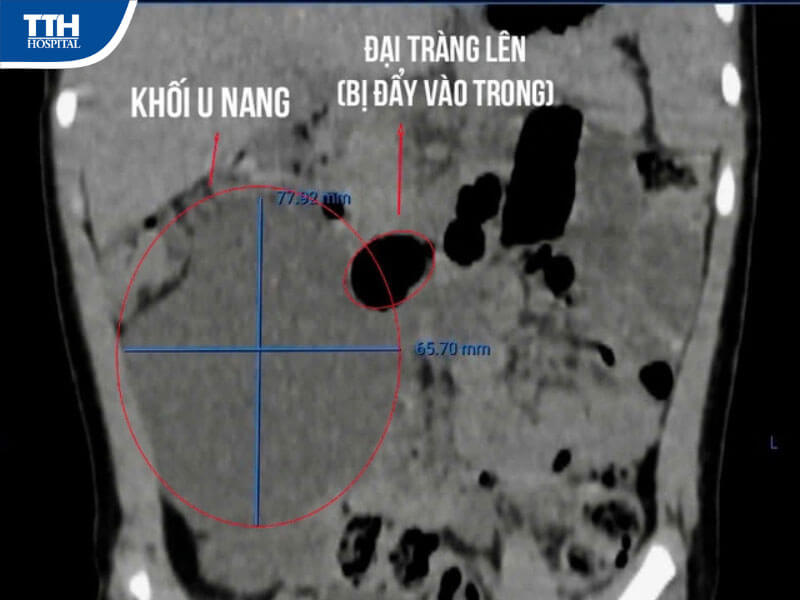 Chẩn đoán hình ảnh phát hiện khối u nang lớn