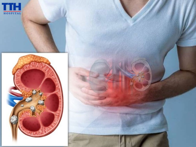 Chẩn đoán sỏi tiết niệu chính xác bằng kỹ thuật hiện đại