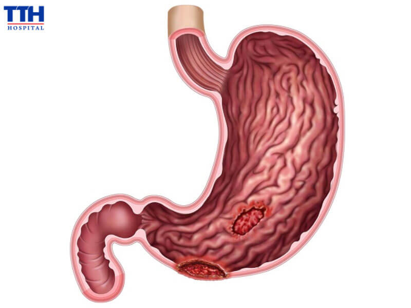 Điều trị đúng nguyên nhân gây bệnh