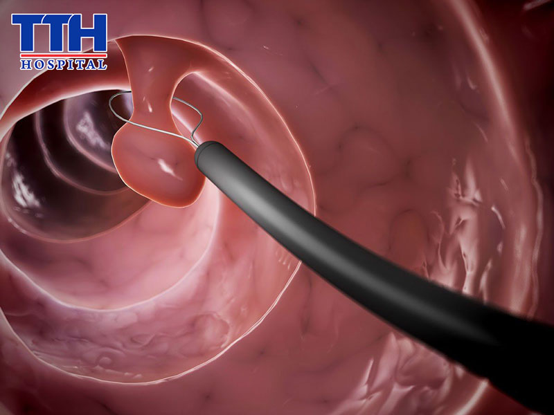 Polyp tiêu hóa được chẩn đoán như thế nào?