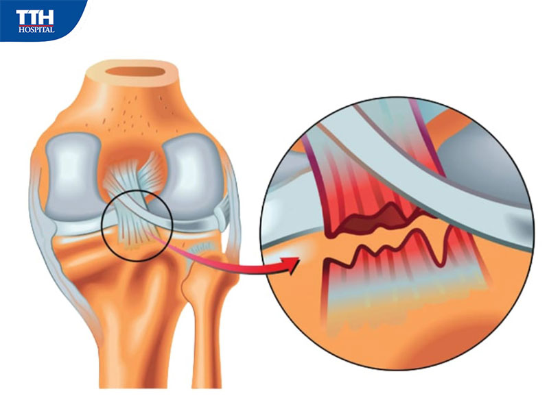Đứt dây chằng chéo trước là gì?