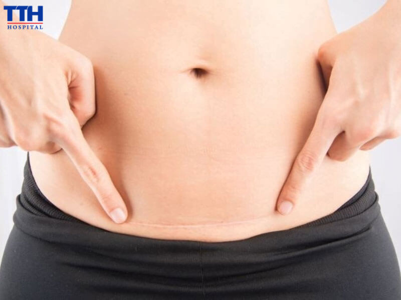 Giảm đau khi sinh mổ – Bước tiến quan trọng của sản khoa hiện đại