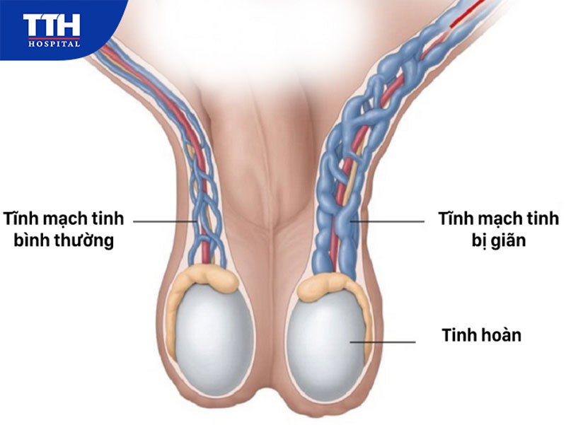 Giãn tĩnh mạch thừng tinh là gì?