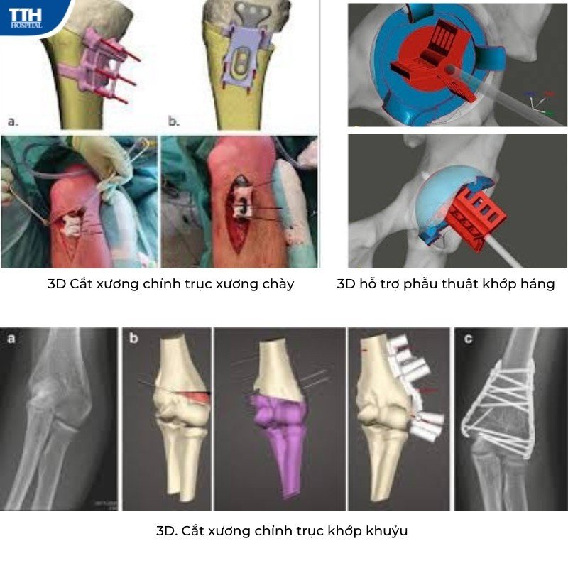 in 3D cắt xương chỉnh trục