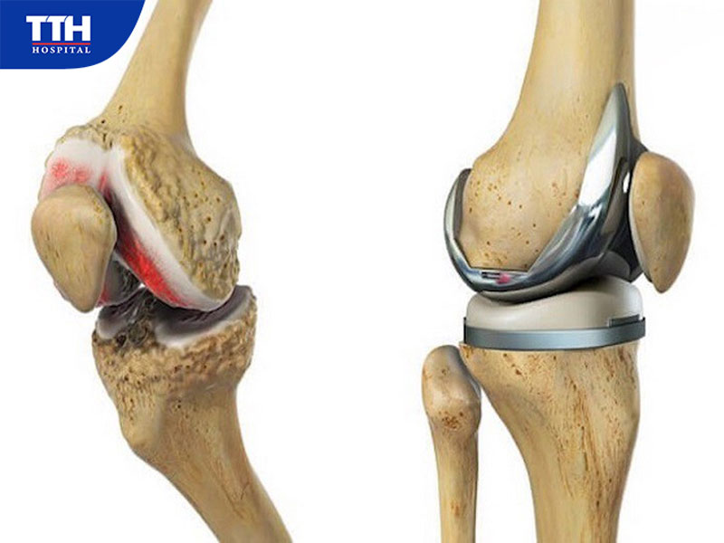 Khi nào cần thay khớp gối nhân tạo?