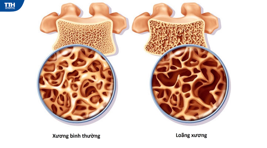 loãng xương TTH Quảng Bình