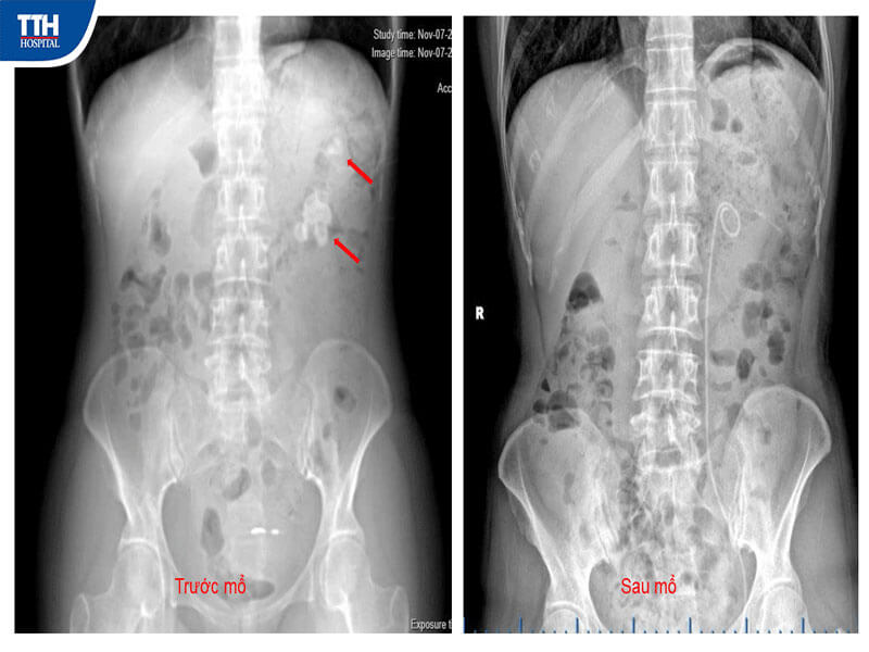 Lựa chọn tối ưu: Tán sỏi qua da đường hầm nhỏ (Mini-PCNL)