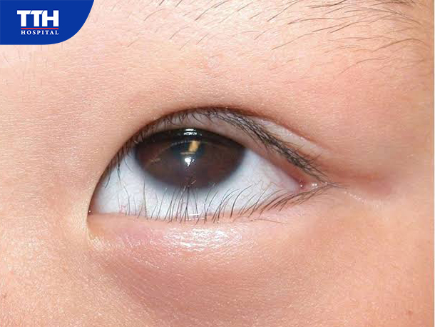 Những dấu hiệu của quặm mi