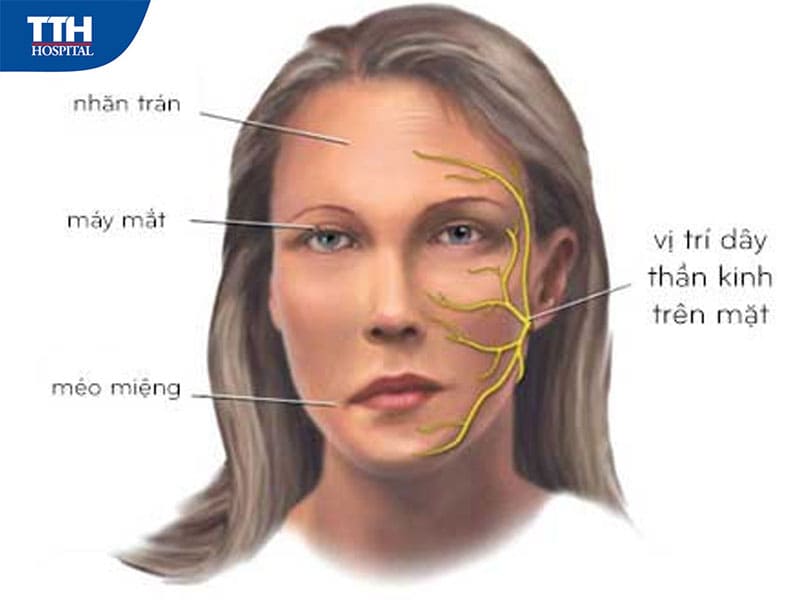 Những lưu ý cần biết trong quá trình điều trị liệt dây thần kinh số 7