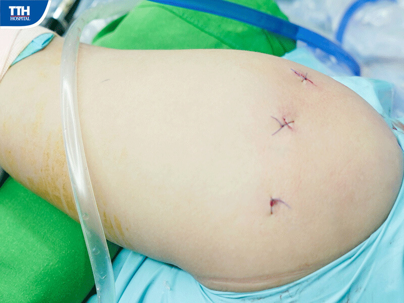 Phẫu thuật nội soi – Giải pháp điều trị hiện đại và hiệu quả