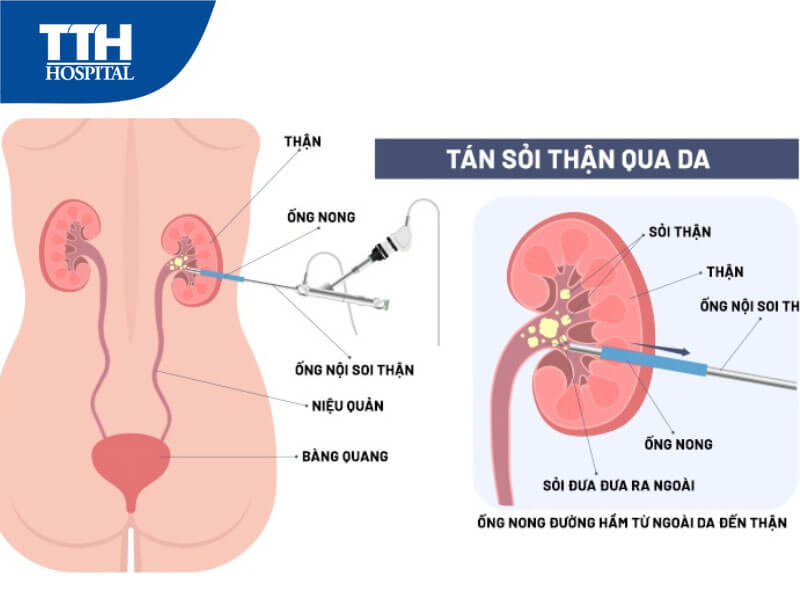 Phẫu thuật nội soi tán sỏi thận qua da đường hầm nhỏ là gì?