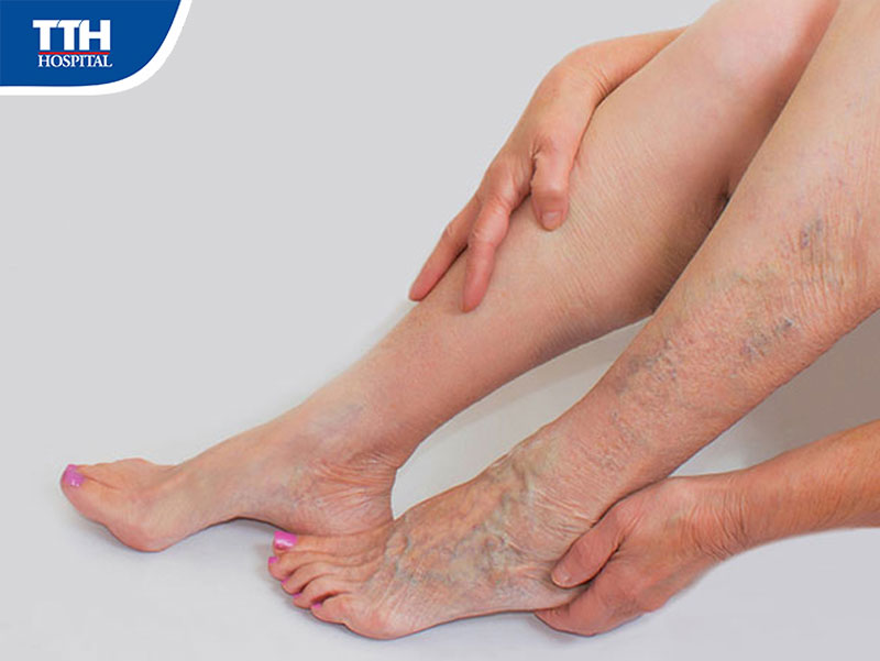 Suy tĩnh mạch mạn tính chi dưới là gì?