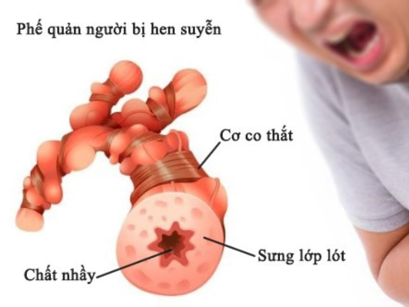 Triệu chứng thường gặp