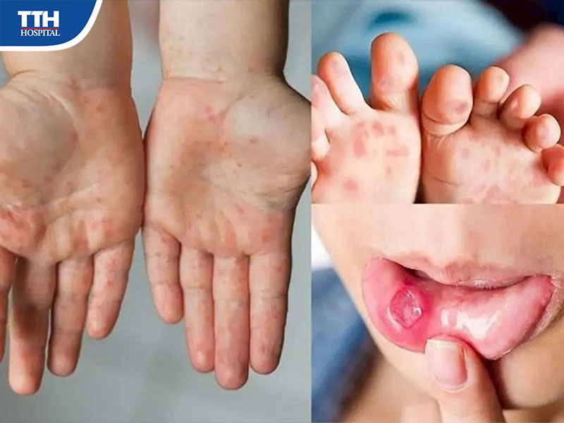 Vì sao trẻ sốt và nổi ban?