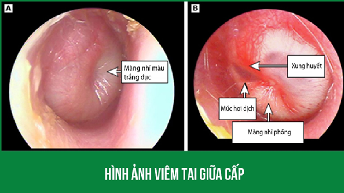 4. Chẩn Đoán Và Kiểm Tra Viêm Tai Giữa