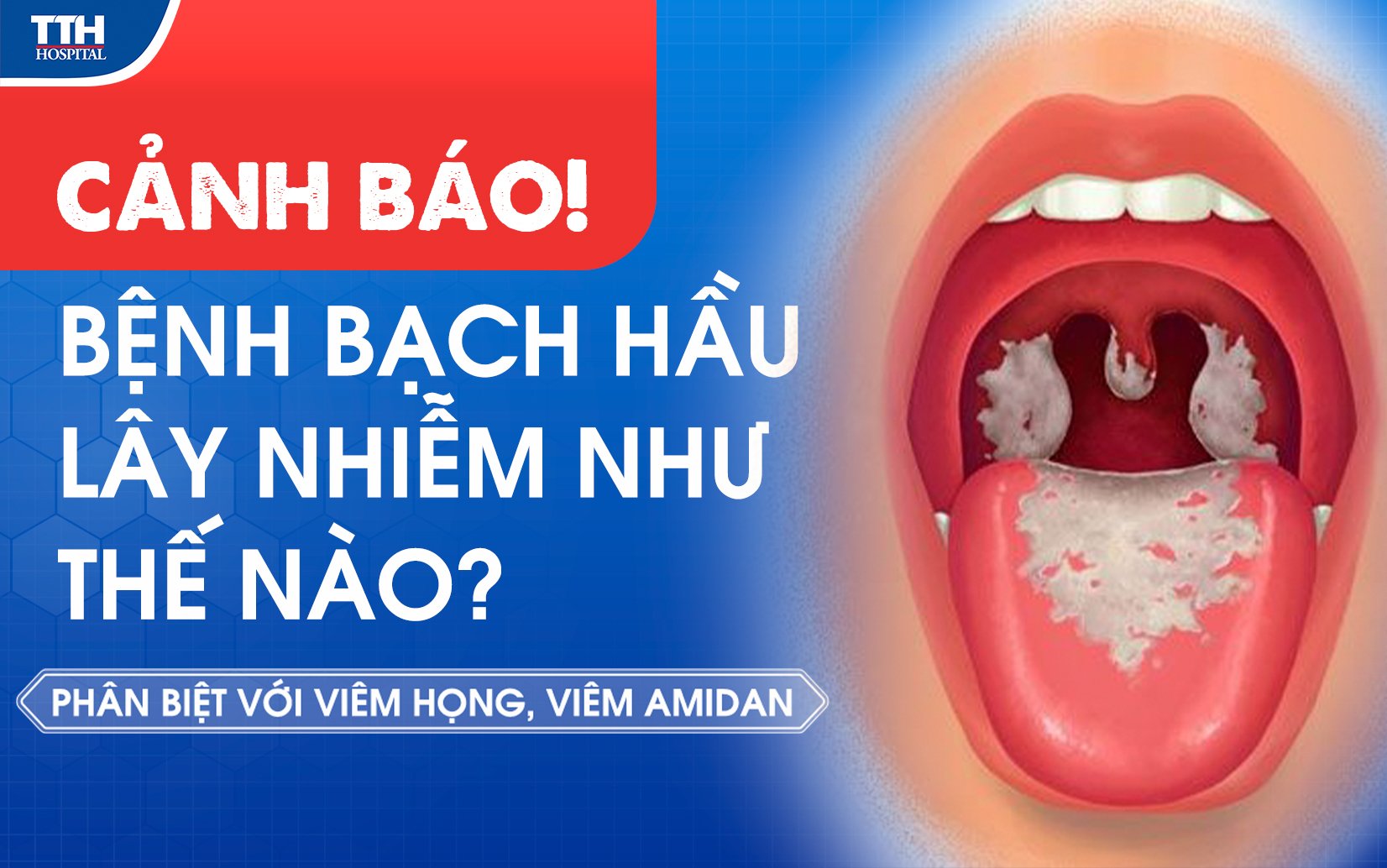 Bạch hầu là gì? bênh bạch hầu lây nhiễm như thế nào?