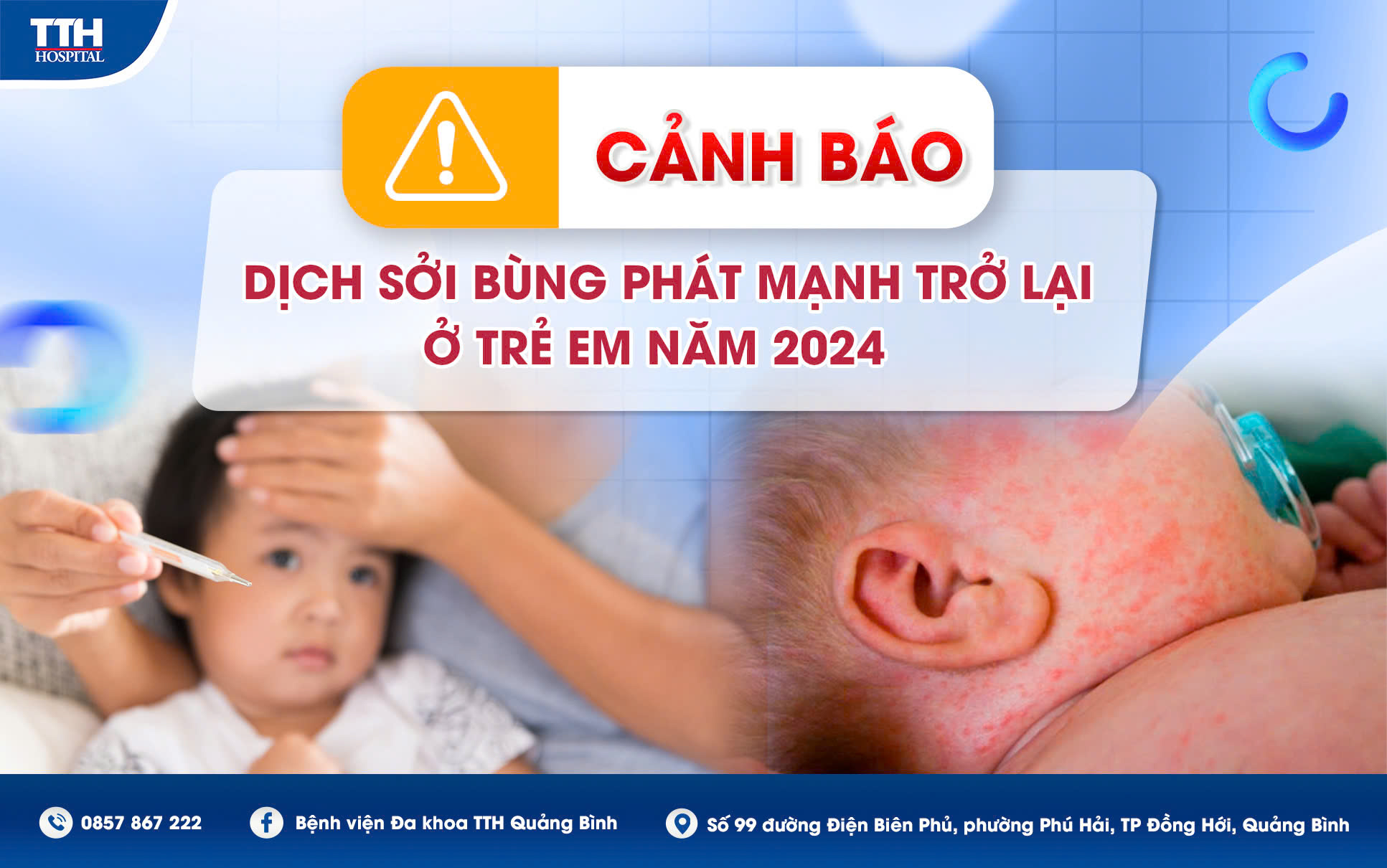 Dịch sởi 2024: Mối nguy hiểm đối với trẻ em và tầm quan trọng của việc thăm khám kịp thời