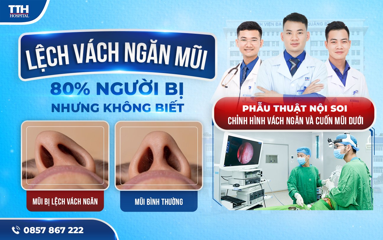 Lệch vách ngăn mũi - 80% người bị nhưng không biết