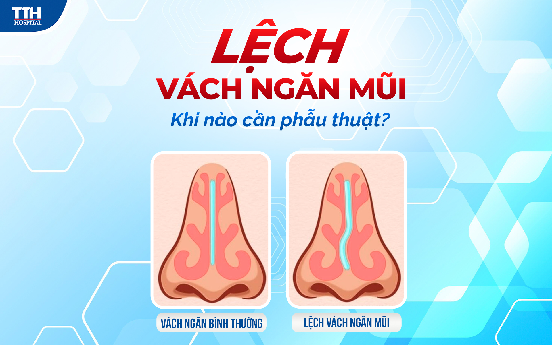 Lệch văn ngăn mũi - Khi nào cần phẫu thuật