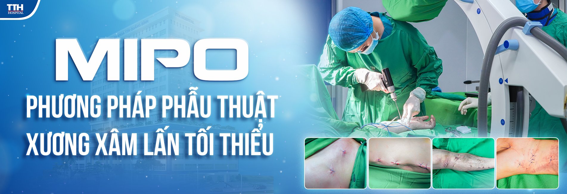 MIPO - Phương pháp phẫu thuật xương xâm lấn tối thiểu