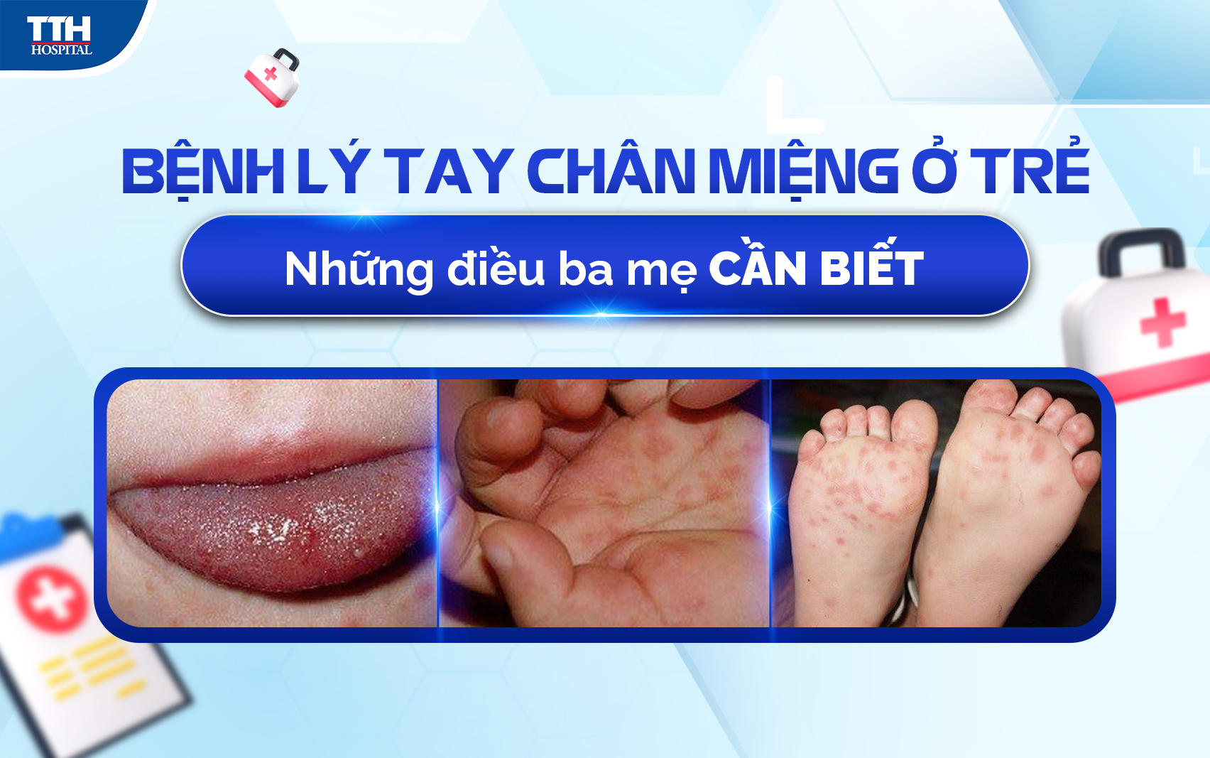 Bệnh tay chân miệng ở trẻ - những điều quan trọng ba mẹ cần biết