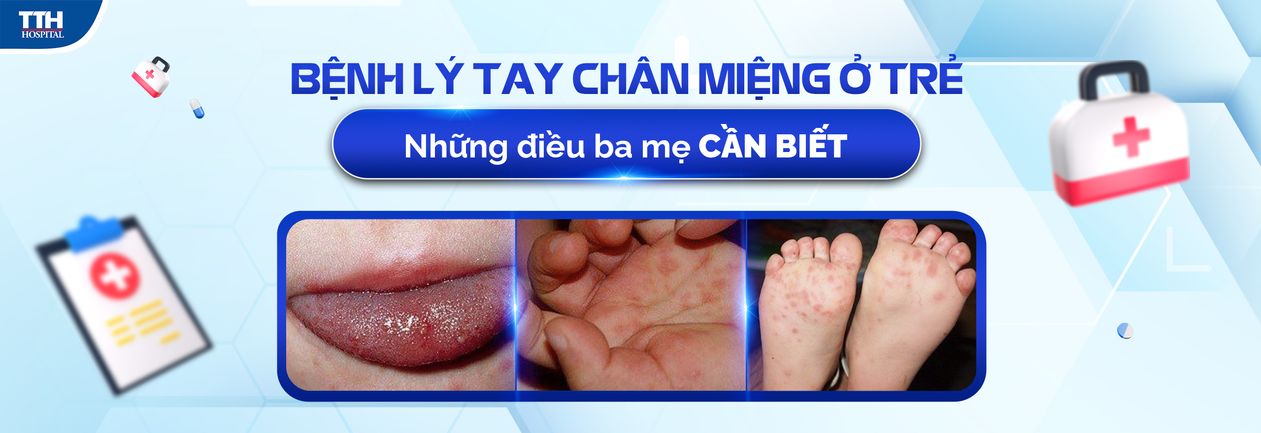 Bệnh tay chân miệng ở trẻ - những điều quan trọng ba mẹ cần biết