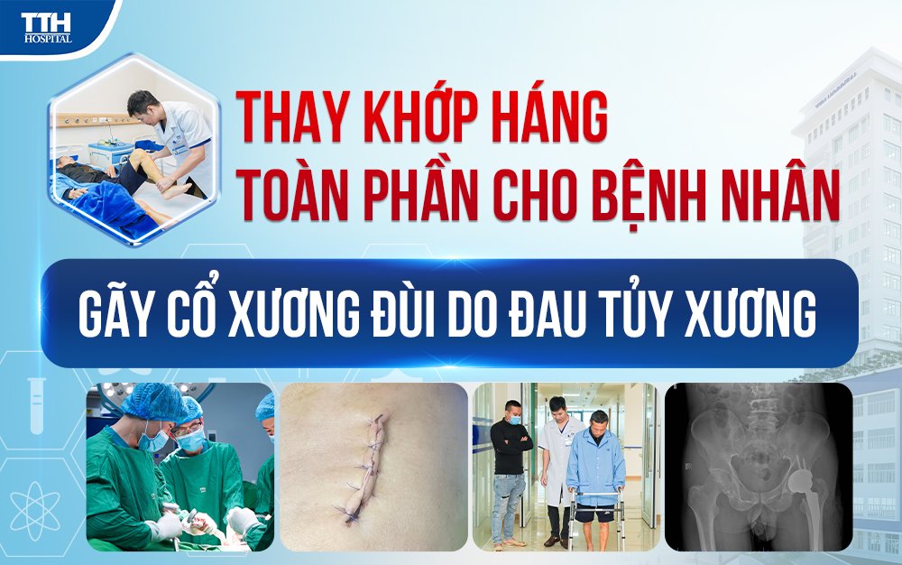 Thay khớp háng toàn phần cho bệnh nhân gãy cổ xương đùi do đa u tủy xương