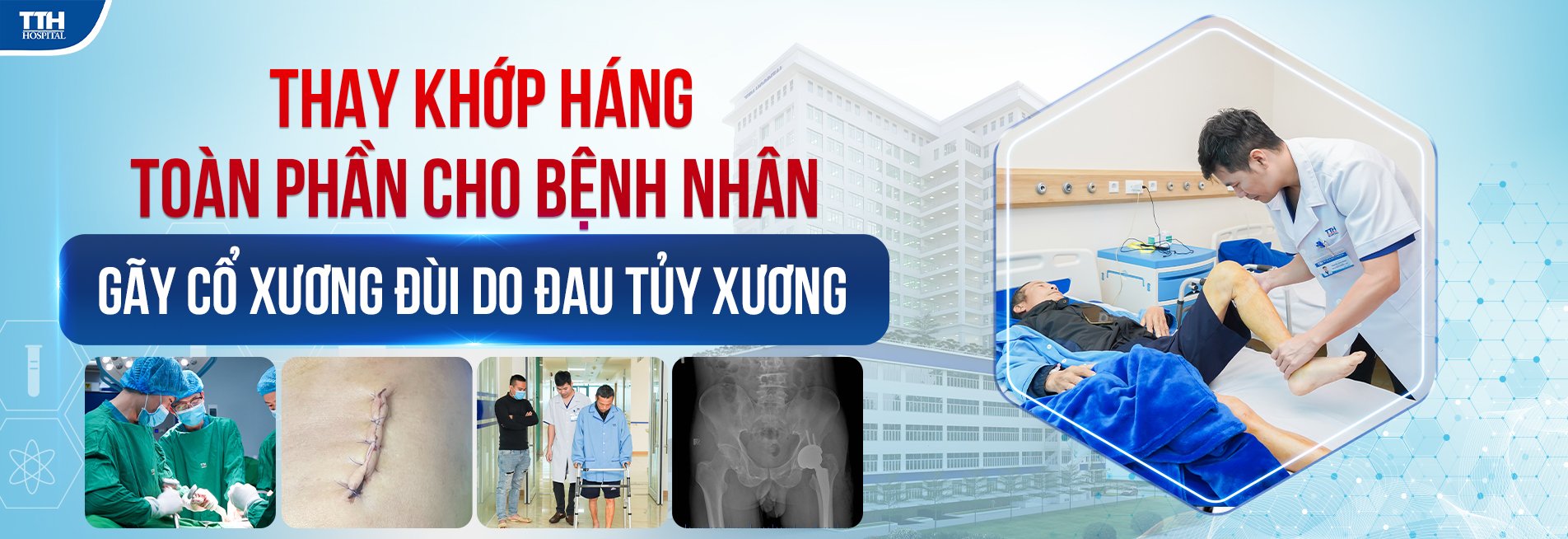 Thay khớp háng toàn phần cho bệnh nhân gãy cổ xương đùi do đa u tủy xương