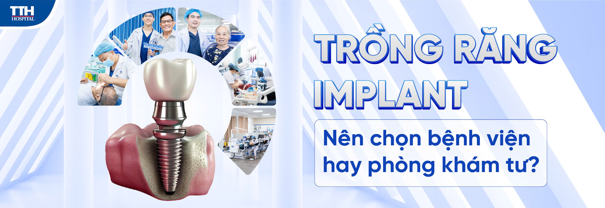 Trồng răng implant - nên chọn bệnh viện hay phòng khám tư?