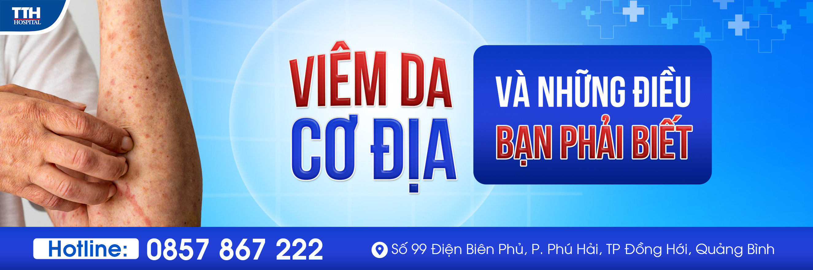 ĐIỀU TRỊ VIÊM DA CƠ ĐỊA TẠI TTH QUẢNG BÌNH Điều trị viêm da cơ địa tại TTH Quảng Bình