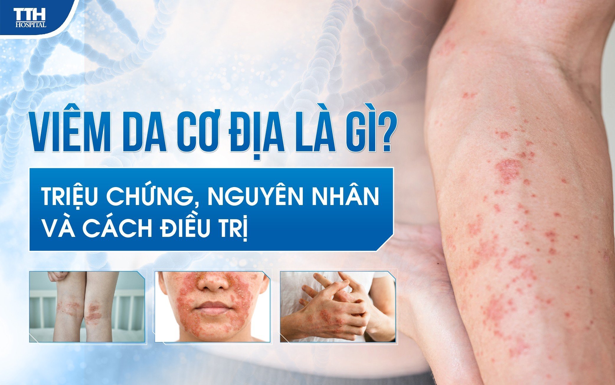 VIÊM DA CƠ ĐỊA LÀ GÌ? NGUYÊN NHÂN TRIỆU CHỨNG VÀ CÁCH ĐIỀU TRỊ?