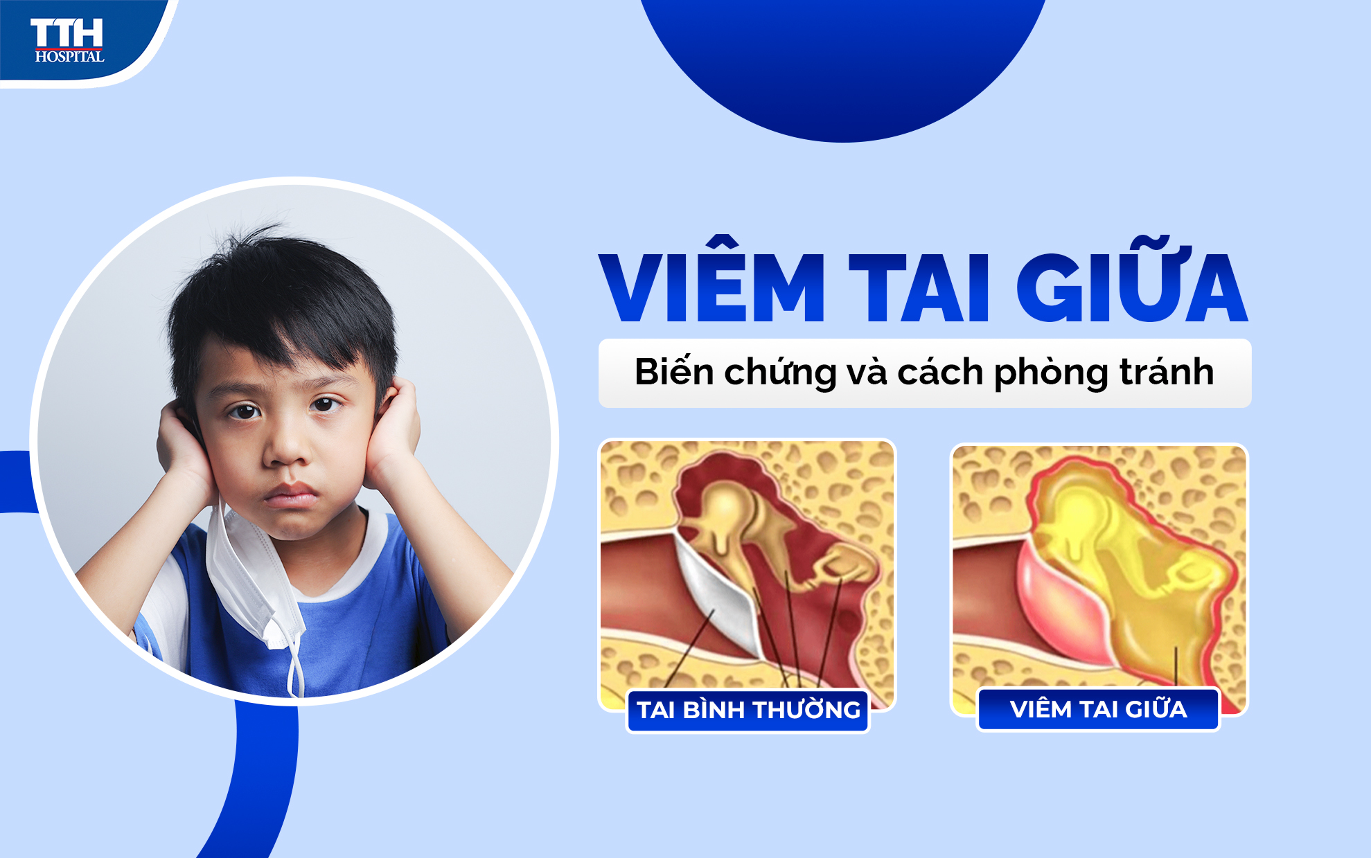 Viêm tai giữa - biến chứng và cách điều trị