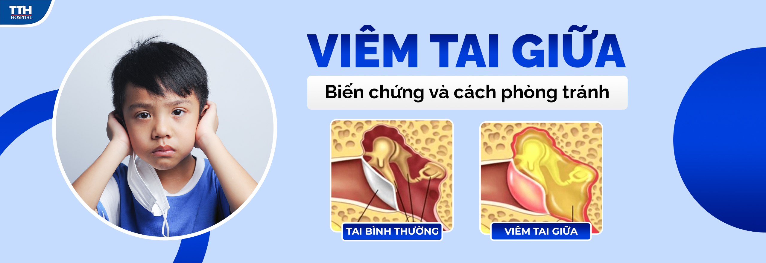 Viêm tai giữa - biến chứng và cách điều trị