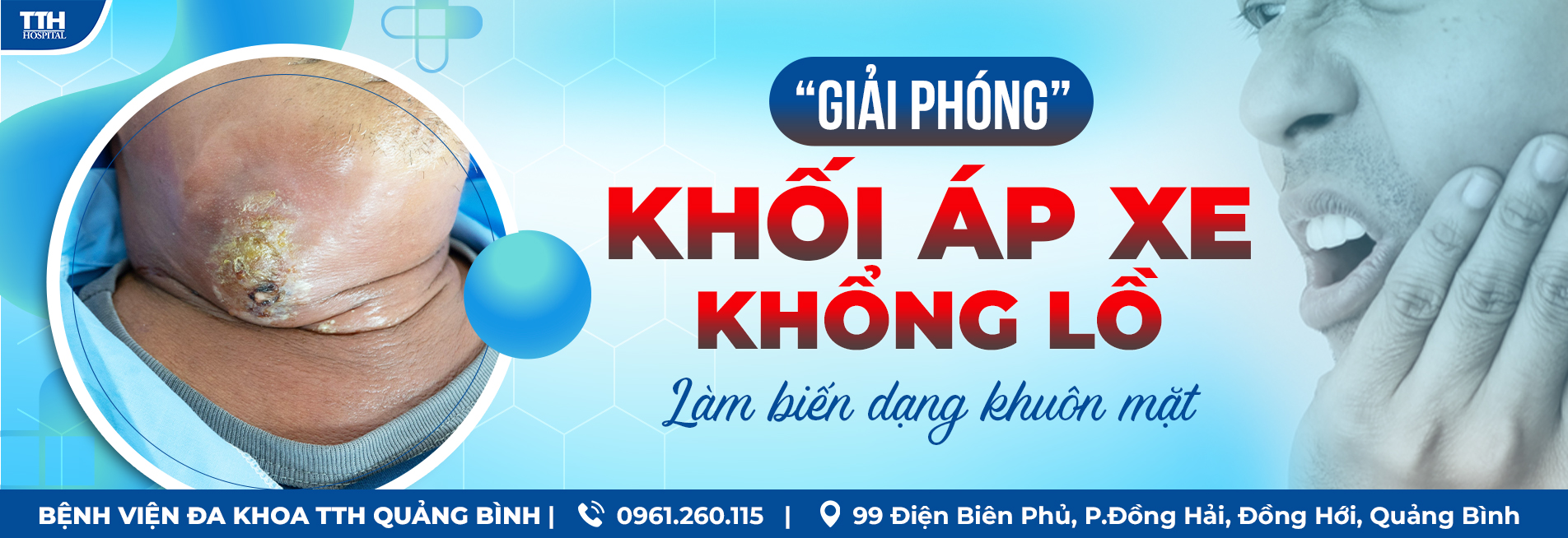 “GIẢI PHÓNG” KHỐI ÁP XE KHỔNG LỒ LÀM BIẾN DẠNG KHUÔN MẶT TẠI BỆNH VIỆN ĐA KHOA TTH QUẢNG BÌNH