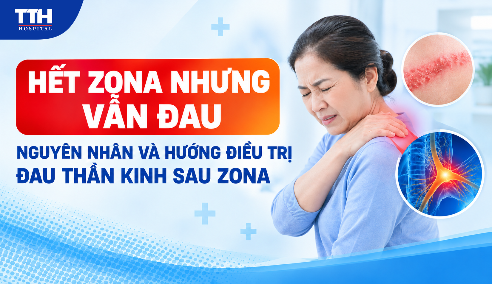 HẾT ZONA NHƯNG VẪN ĐAU: NGUYÊN NHÂN VÀ HƯỚNG ĐIỀU TRỊ ĐAU THẦN KINH SAU ZONA