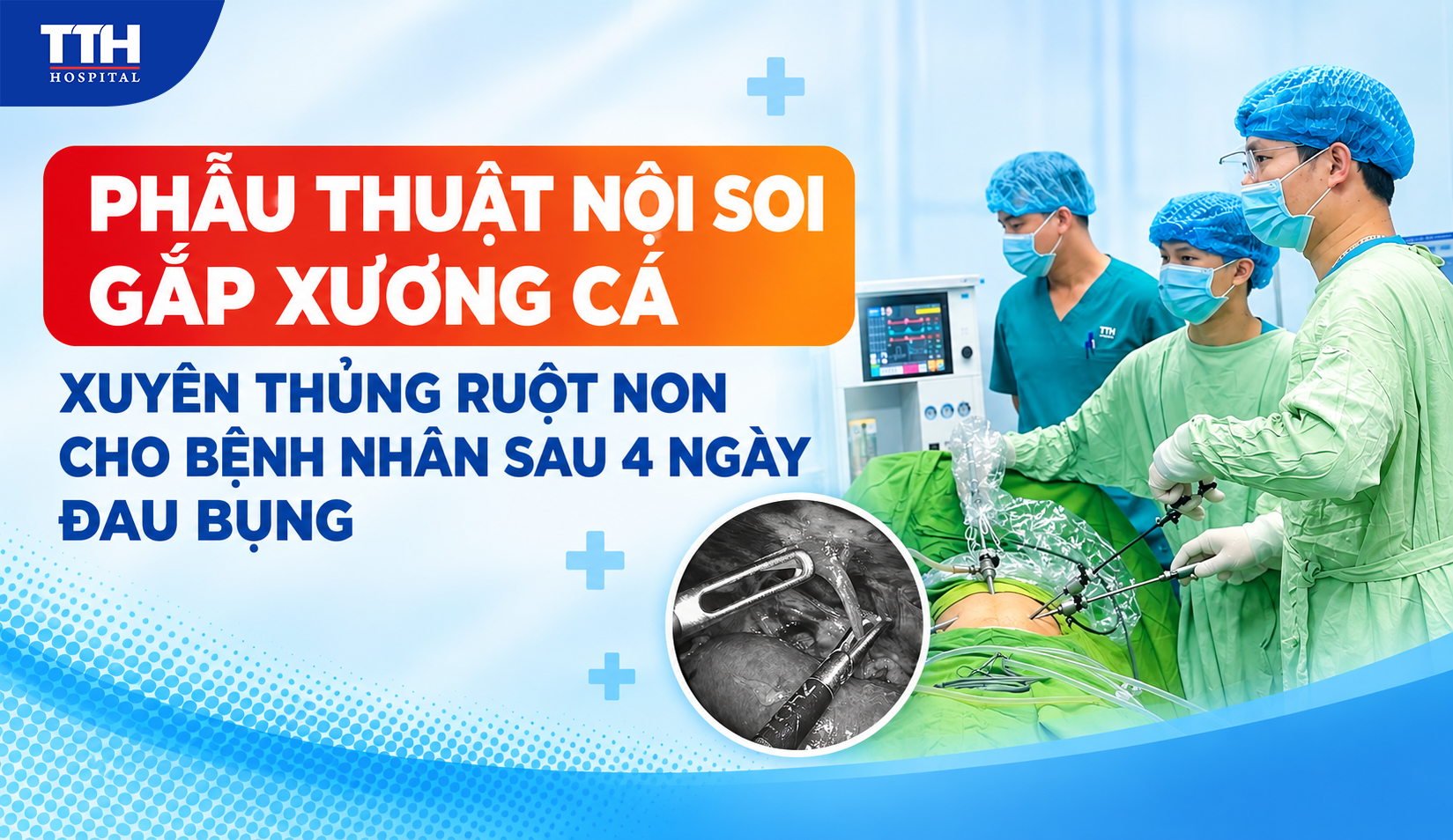 PHẪU THUẬT NỘI SOI GẮP XƯƠNG CÁ XUYÊN THỦNG RUỘT NON CHO BỆNH NHÂN SAU 4 NGÀY ĐAU BỤNG