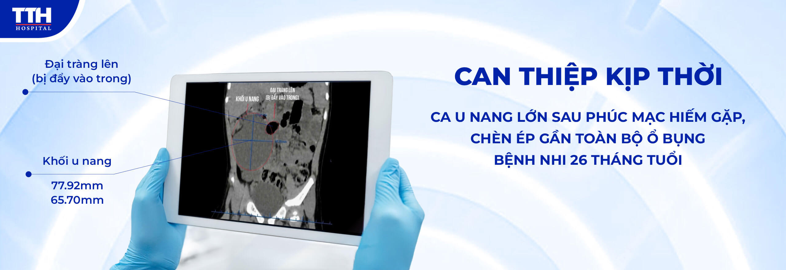 CAN THIỆP KỊP THỜI CA U NANG LỚN SAU PHÚC MẠC HIẾM GẶP Ở BỆNH NHI 26 THÁNG TUỔI