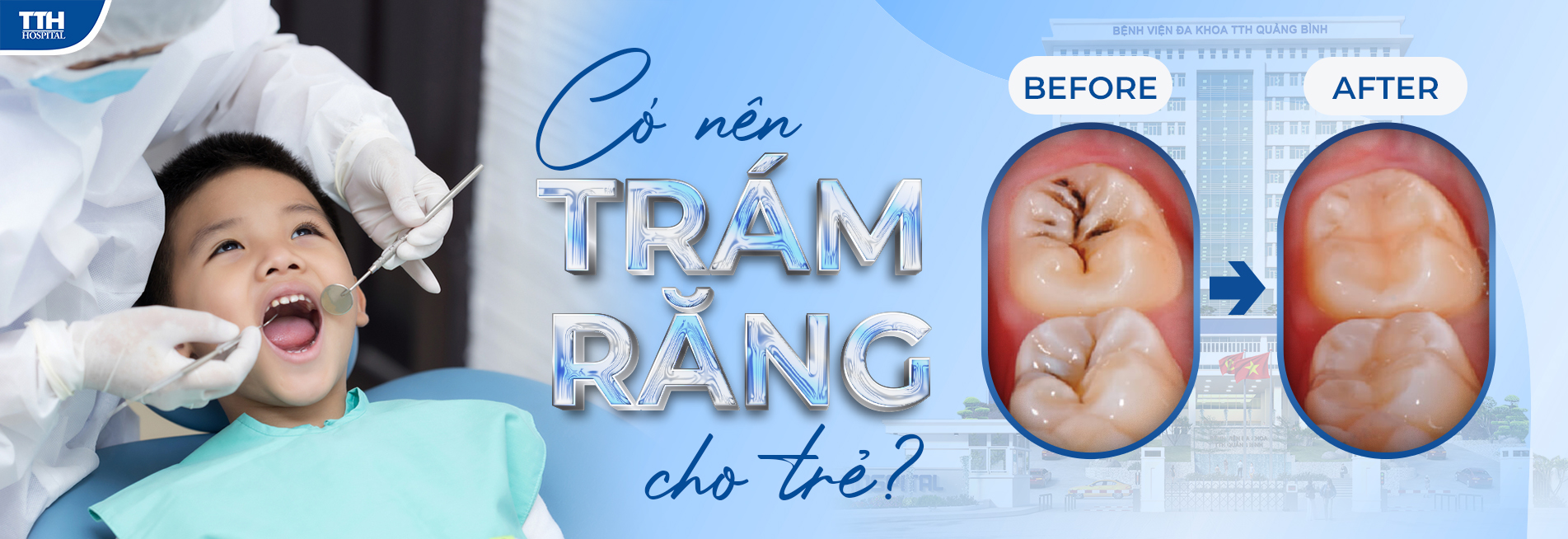 Có nên trám răng cho trẻ không?