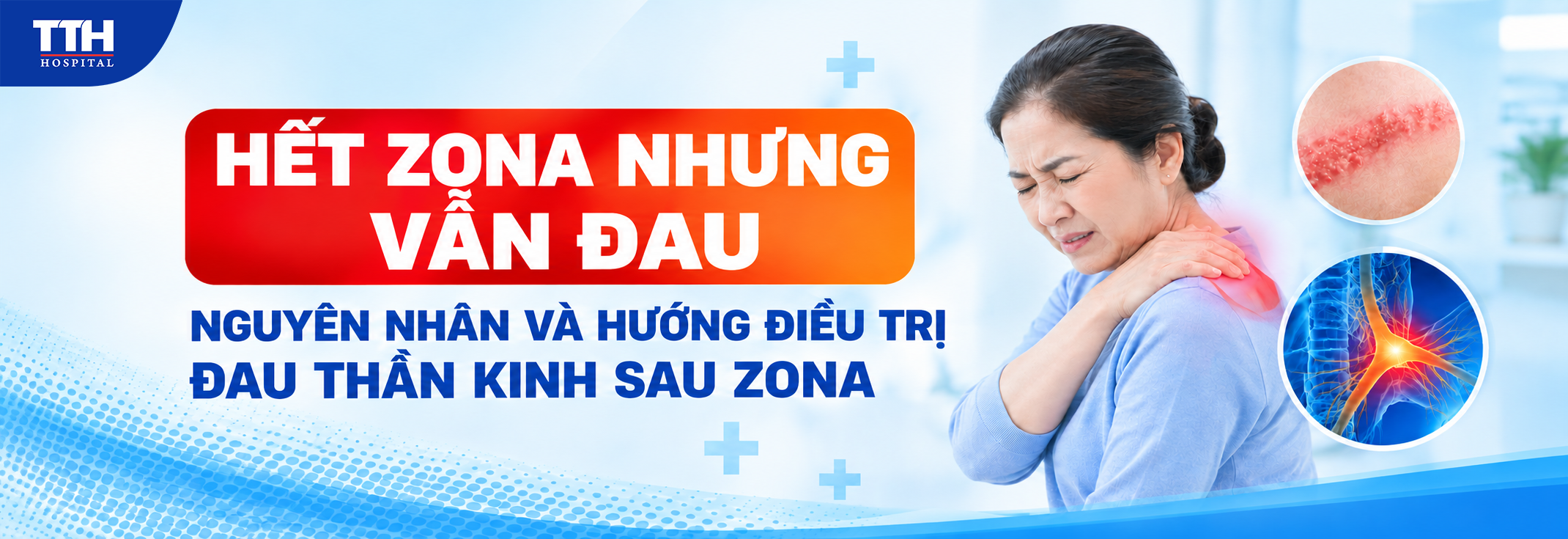 HẾT ZONA NHƯNG VẪN ĐAU: NGUYÊN NHÂN VÀ HƯỚNG ĐIỀU TRỊ ĐAU THẦN KINH SAU ZONA