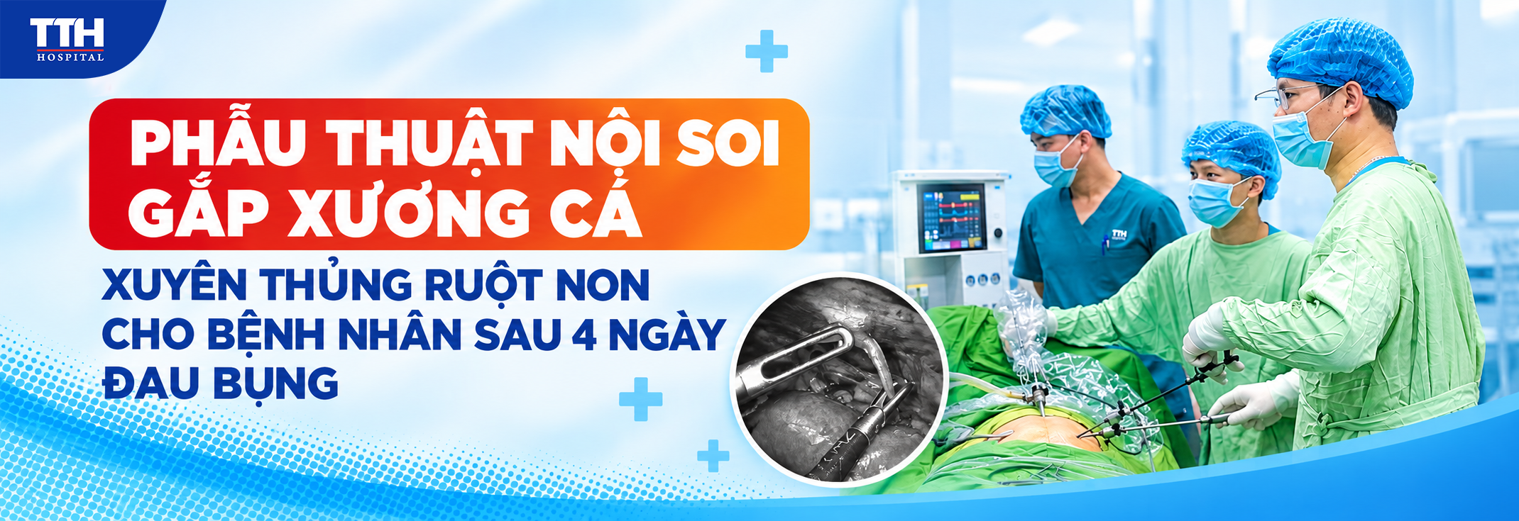 PHẪU THUẬT NỘI SOI GẮP XƯƠNG CÁ XUYÊN THỦNG RUỘT NON CHO BỆNH NHÂN SAU 4 NGÀY ĐAU BỤNG
