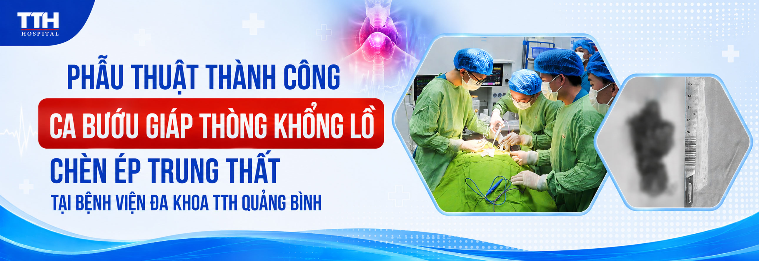 PHẪU THUẬT THÀNH CÔNG CA BƯỚU GIÁP THÒNG KHỔNG LỒ HIẾM GẶP CHÈN ÉP TRUNG THẤT