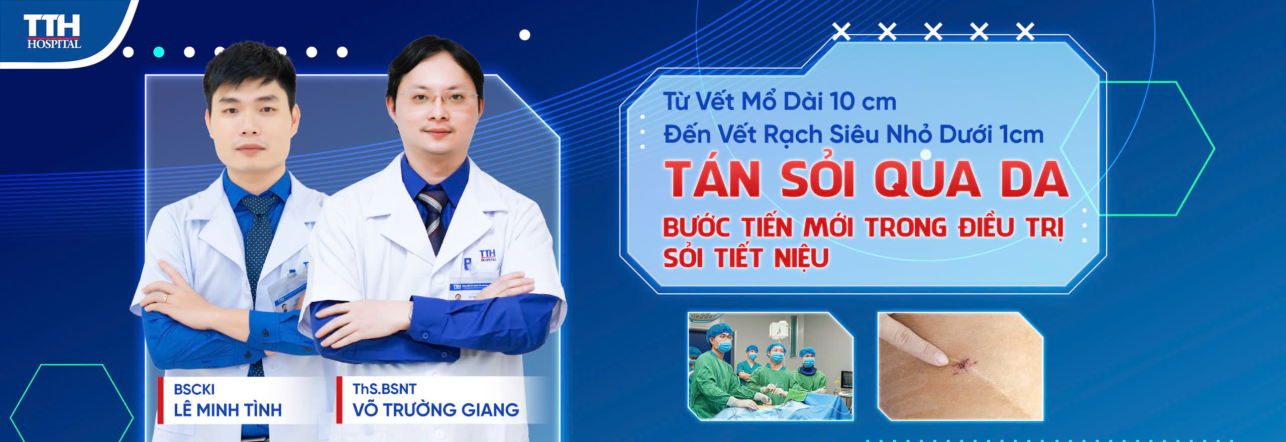 Tán sỏi qua da - bước tiến mới trong điều trị sỏi niệu quản