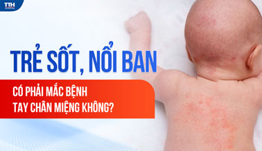 TRẺ SỐT, NỔI BAN - CÓ PHẢI TAY CHÂN MIỆNG KHÔNG?