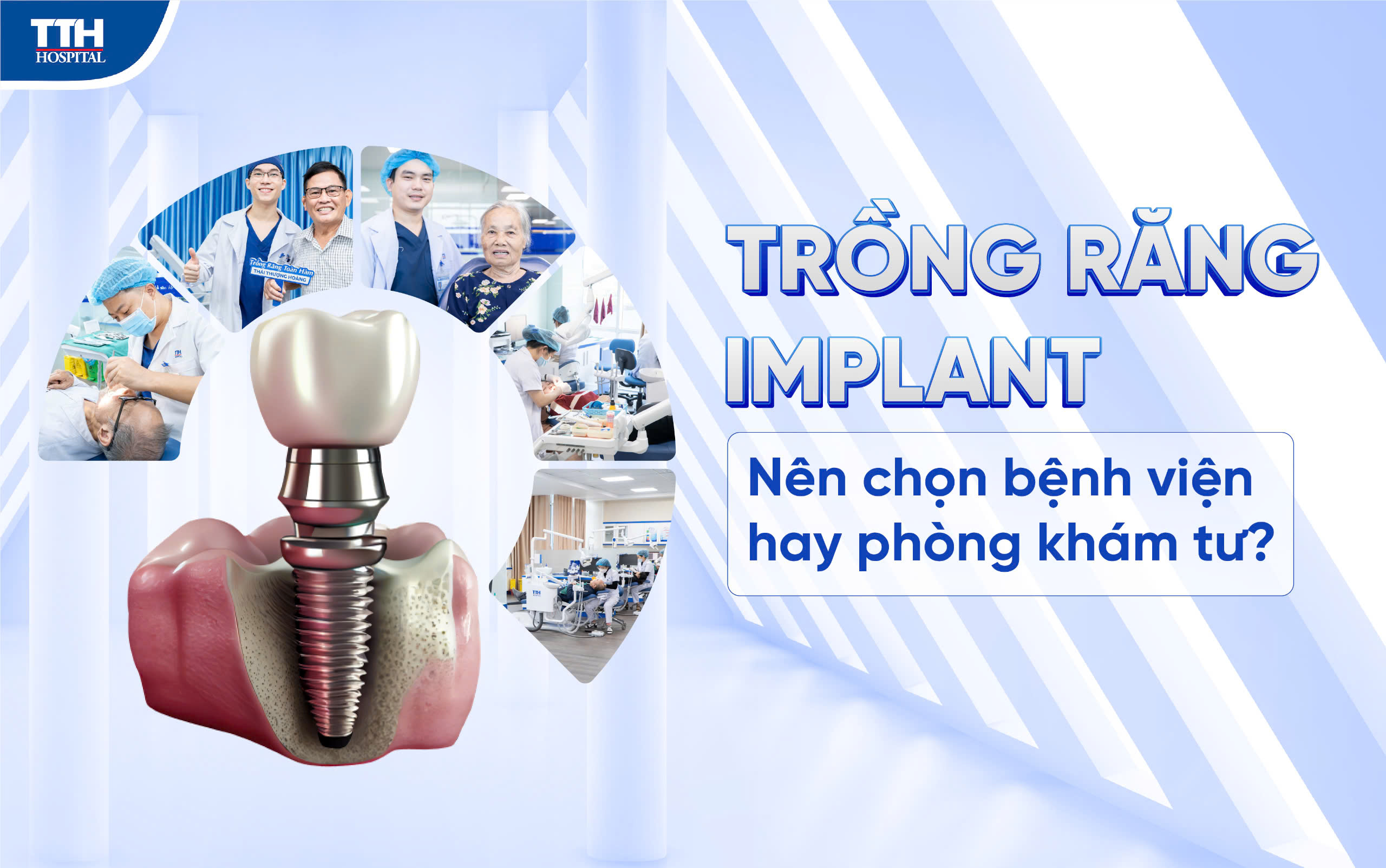 Trồng răng implant - nên chọn bệnh viện hay phòng khám tư?